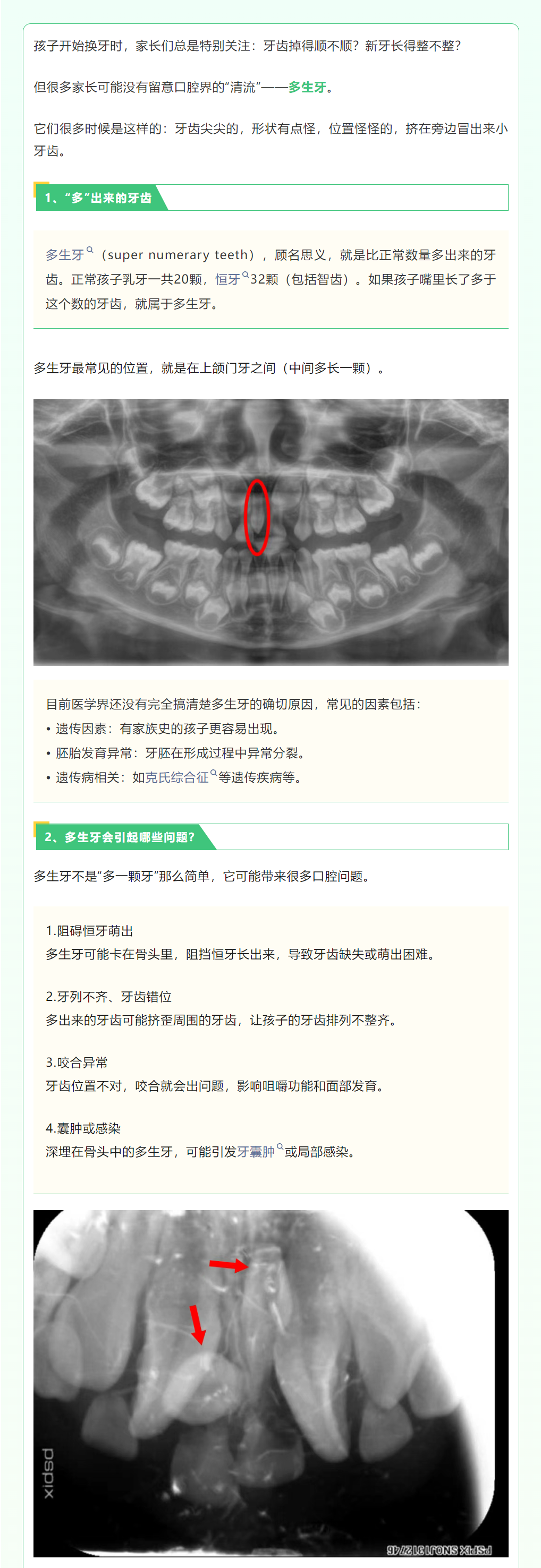 1门牙却露尖尖角，小心突然冒出的“多生牙”.png