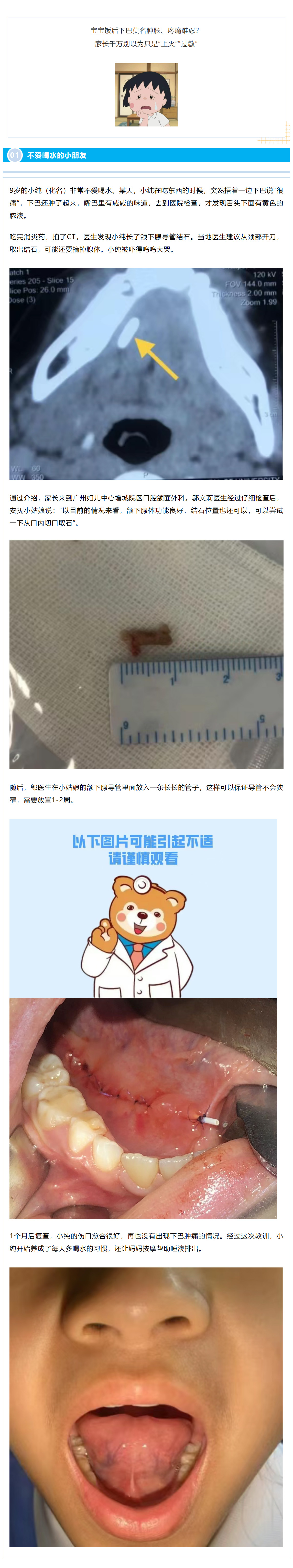 1宝宝进食后，下巴居然肿了？可能是唾液腺结石在“捣蛋”.jpg